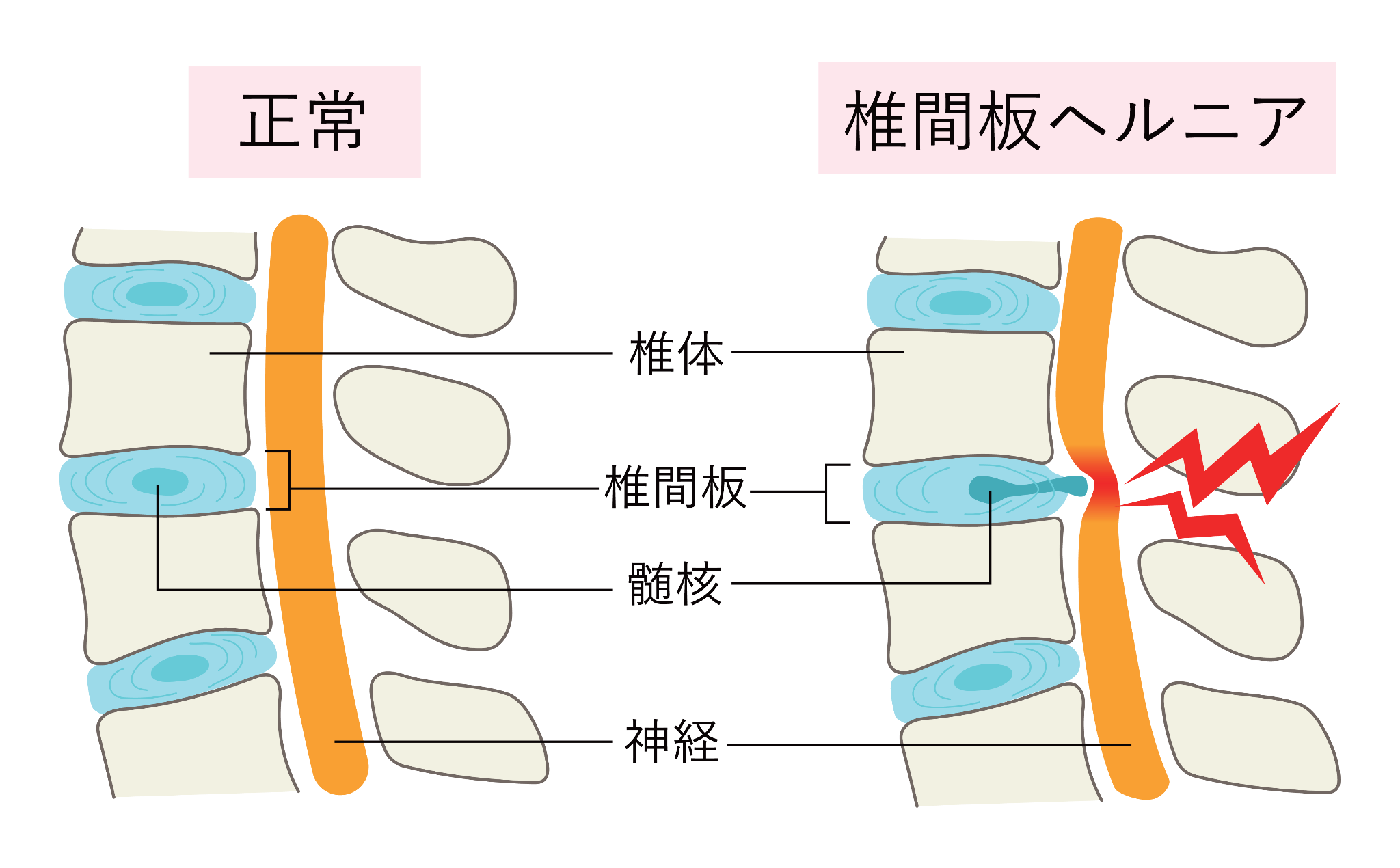 腰痛図①